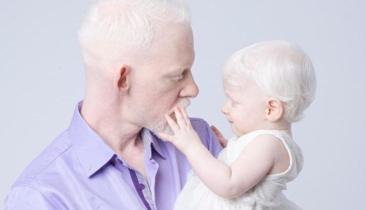 Persons with albinism in the MENA region fight for their