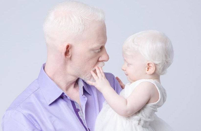 Persons with albinism in the MENA region fight for their rights