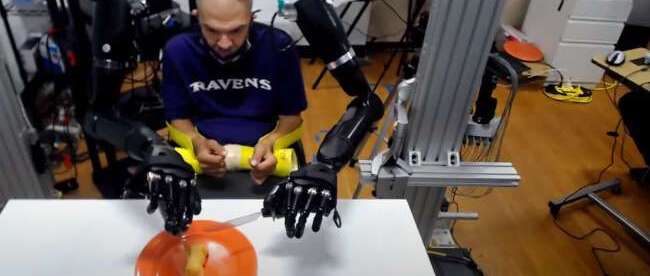 Quadriplegic Man Controls Two Prosthetic Arms Simultaneously Using Brain Interface